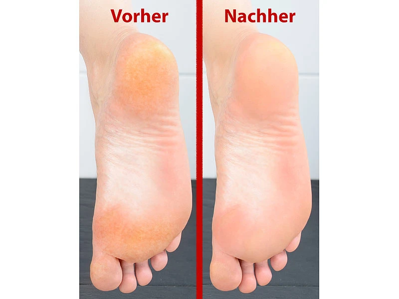 Sichler Beauty Hornhautraspler:Elektrischer Hornhaut-Entferner SB-30.bc Mit 2 Schleif-Köpfen 6 Sichler Beauty Hornhautraspler:Elektrischer Hornhaut-Entferner SB-30.bc Mit 2 Schleif-Köpfen – Bild 6